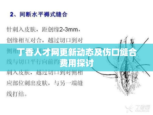 丁香人才网更新动态及伤口缝合费用探讨